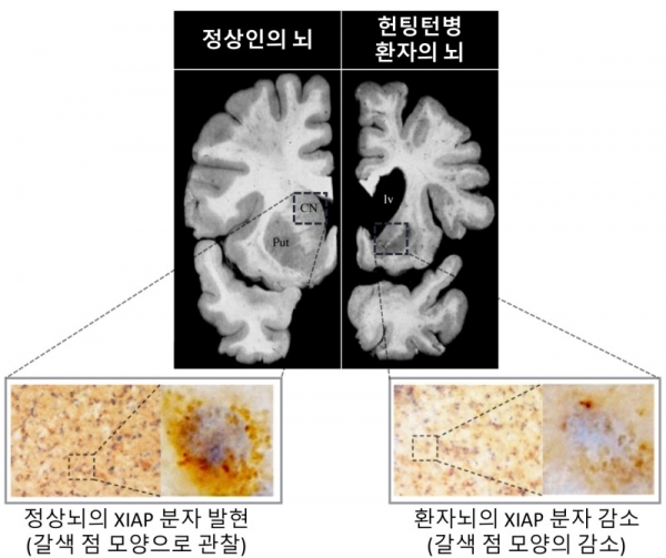 정상인의 뇌와 헌팅턴병 환자의 뇌에서 XIAP 분자의 발현 정도가 뚜렷하게 차이가 남을 보여준다. (XIAP 분자를 면역조직화학법으로 염색해 갈색으로 관찰 할 수 있게 처리함, 헌팅턴 환자의 뇌에서 XIAP분자의 발현이 낮음을 확인) (이미지=한국과학기술연구원)