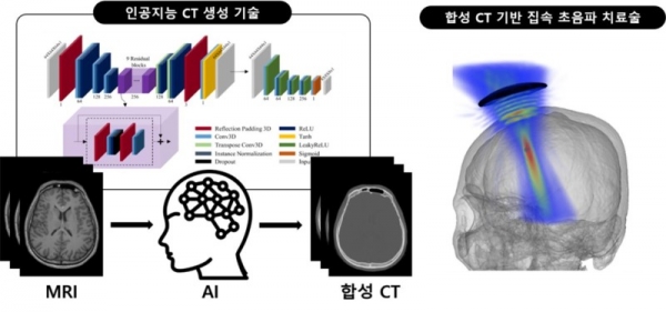 인공지능 합성 CT 기반 집속 초음파 치료술 모식도​.